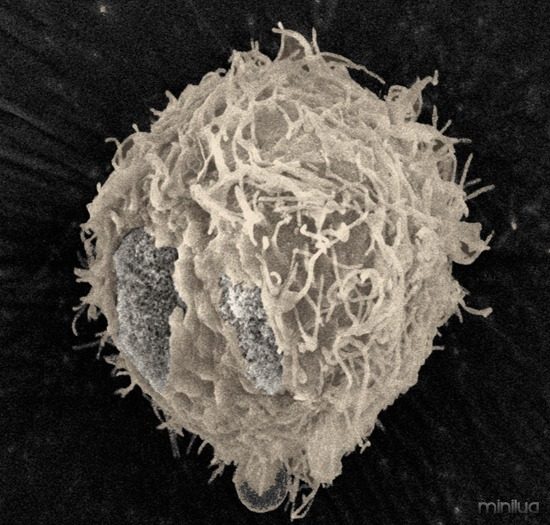 celula cancer prostata