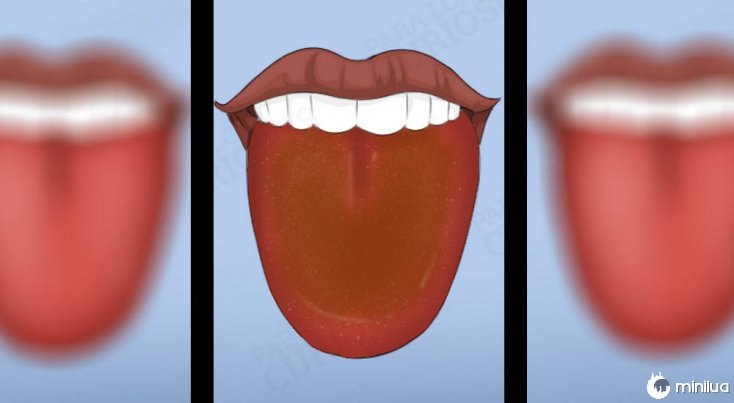Os sintomas língua colorido com revestimento castanho