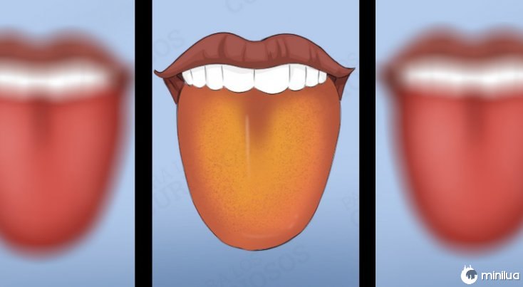 Os sintomas língua camada de cor amarela