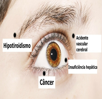 8 coisas que seus olhos estão tentando lhe dizer sobre sua saúde