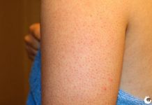 Você tem essas manchas vermelhas na sua pele? Saiba porque elas existem.