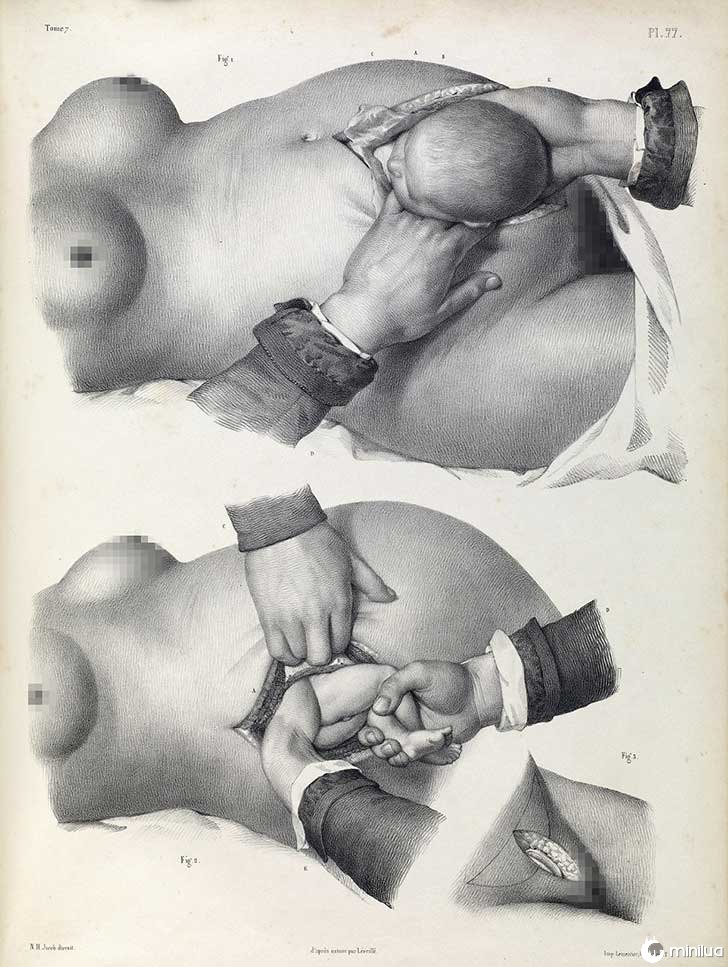 século barbara cirurgia 19 4