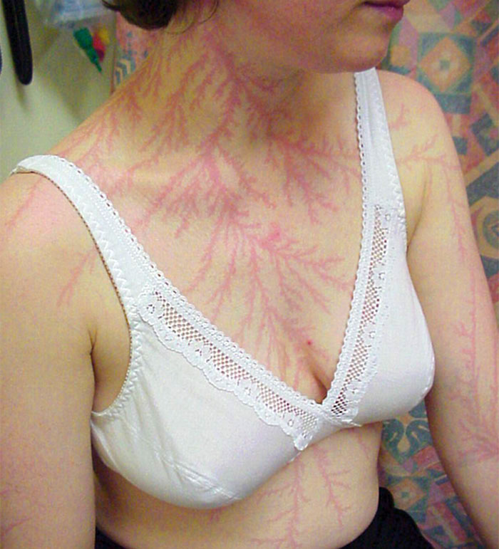 Cicatrizes-Depois-Sobrevivendo-Relâmpago-Greve-Lichtenberg-Figuras-Fotos-18