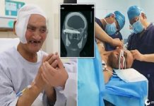 Cirurgião retira faca enferrujada embutida na cabeça do homem por 26 anos