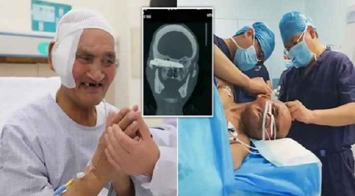 Cirurgião retira faca enferrujada embutida na cabeça do homem por 26 anos