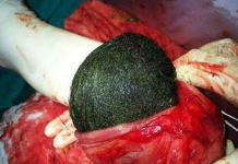 Mulher viciada em comer o próprio cabelo tem bola de pêlo gigante removida do estômago
