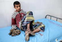 O homem da árvore em breve fará uma cirurgia para remover a casca dele