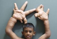 Cirurgia da mão para o menino indiano que sofria de gigantismo é um sucesso
