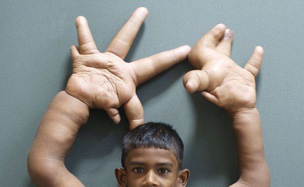 Cirurgia da mão para o menino indiano que sofria de gigantismo é um sucesso