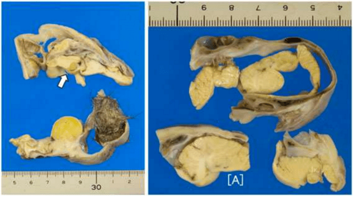 Brain bone hair ovary tumor teenage girl japan