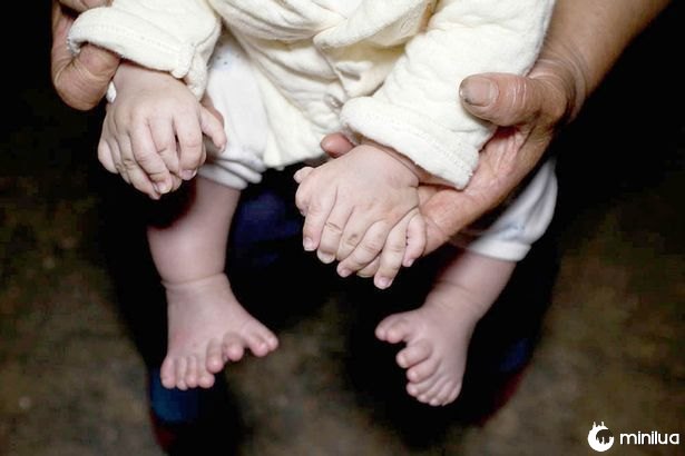 Polydactyly Chinese Baby