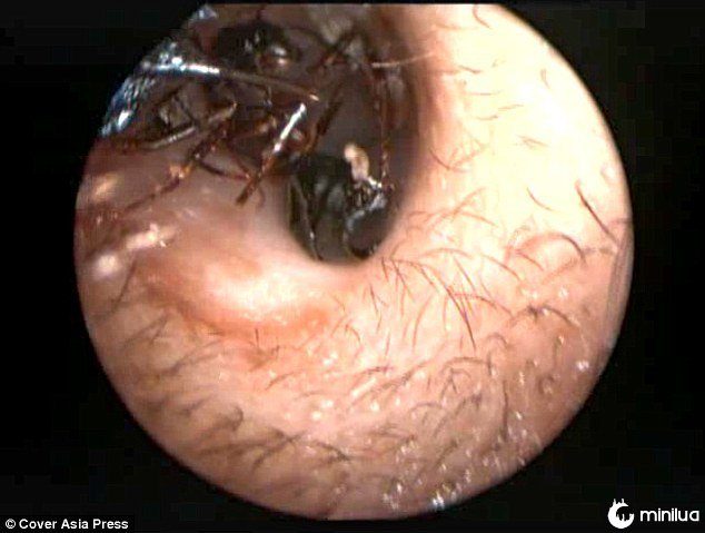 Ants in ear canal