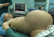 O "homem grávido" que retirou de 33 quilos de peso após cirurgia
