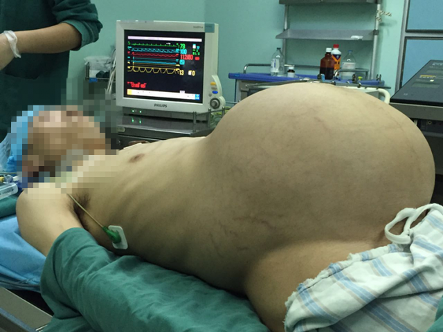 Pregnant man china tumor