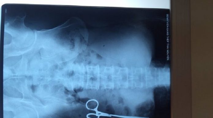 Tesoura removida da barriga do homem após 18 anos
