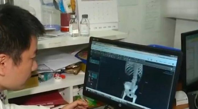 Homem remove enguia de 15 polegadas após inseri-la no ânus para 'curar constipação'