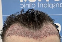 Transplante capilar barato deixou cicatrizes e não fez o cabelo crescer