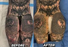 Modelo que tatuou seus olhos mostra os resultados da cirurgia no bumbum