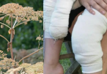 Menina de cinco anos deixada com bolhas graves após encontrar Hogweed gigante
