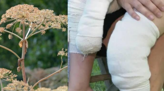 Menina de cinco anos deixada com bolhas graves após encontrar Hogweed gigante