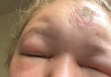 Jovem, alerta sobre envenenamento solar que a deixou incapaz de abrir os olhos