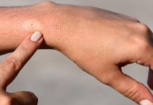 Picadas de inseto: é melhor prevenir do que remediar