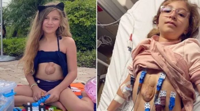 Menina de 11 anos, nasceu com o coração batendo fora do peito